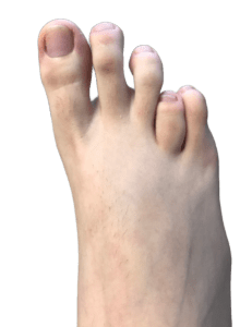 brachymétatarsie orteils des pieds en Tunisie