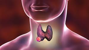Cancer de la thyroïde Tunisie