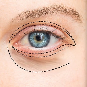 Canthopexie - Chirurgie du contour des yeux en Tunisie prix tarif pas cher