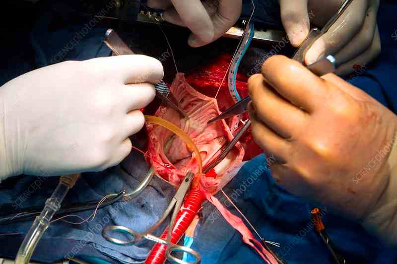 Chirurgie valvulaire cardiaque - Tunisie Esthetic