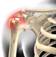 Tendinopathie calcification de l’épaule en Tunisie prix tarif pas cher