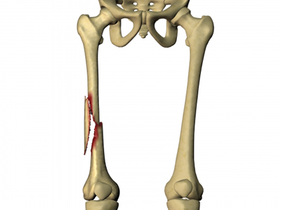 Fracture du fémur en Tunisie prix pas cher