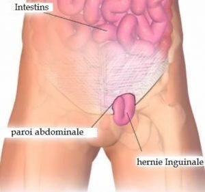 hernie inguinale ombilicale en Tunisie prix tarif pas cher