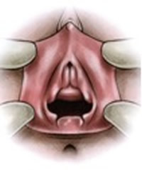 Hymenoplastie - reconstruction de l'hymTunisie prix tarif pas cher