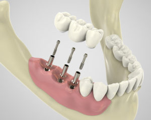 Implant dentaire en Tunisie prix pas cher