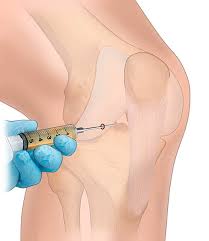 Injections intra-articulaires Tunisie