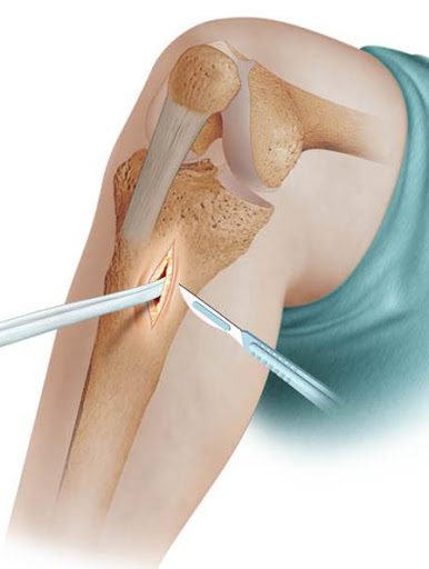 Ligamentoplastie en Tunisie - rupture ligament croisé - LCA à prix attractifs et pas cher