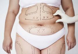 Liposuccion Full HD traitement contouring musculaire Tunisie