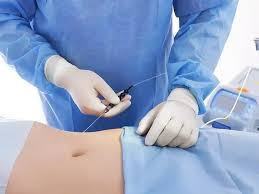 Liposuccion Vaser traitement graisses localisées Tunisie