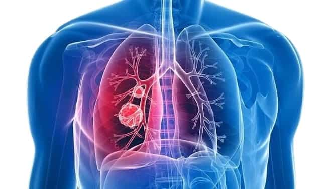 Lobectomie pulmonaire en Tunisie