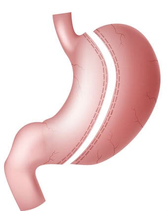 Sleeve Gastrectomie gastrique Tunisie prix pas cher