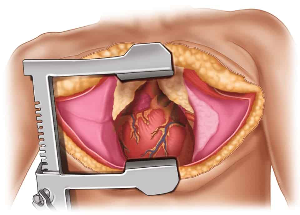 Chirurgie de la thoracotomie en Tunisie