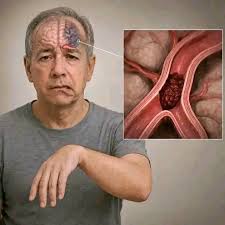 Thrombophlébite cérébrale - diagnostic IRM en Tunisie