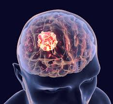 Tumeurs cérébrales - diagnostic IRM et neurochirurgie en Tunisie